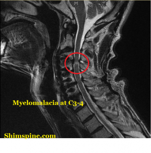 myelopathy sign cervical hoffmann spine cord spinal shim compression symptoms uterine cancers most cancer