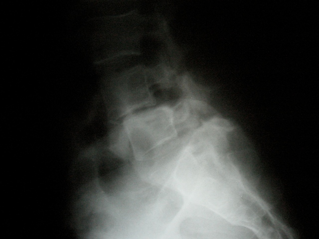 How Come my Doctor did not order an X-Ray?