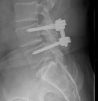 Why Plates and Screws?