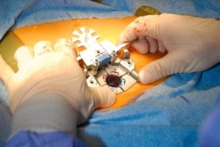 Minimally Invasive Discectomy vs Micro/Open Discectomy