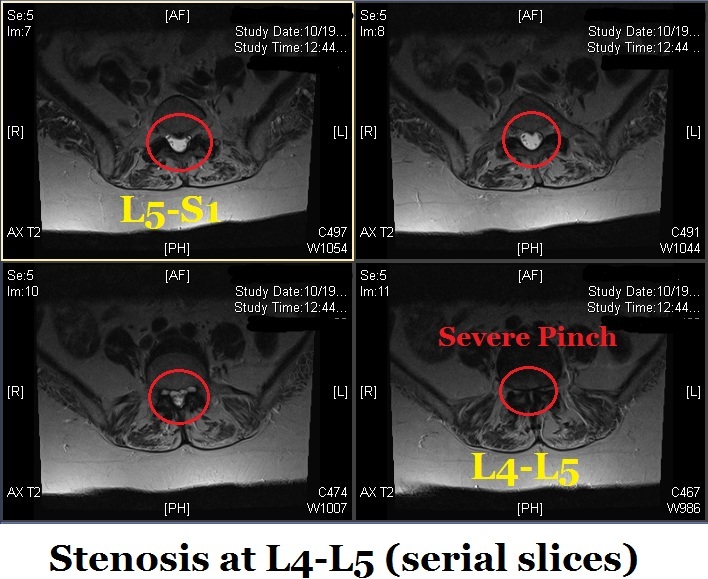 Does Everyone Get Spinal Stenosis?