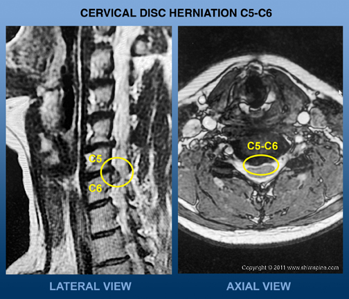 Neck Pain Treatment