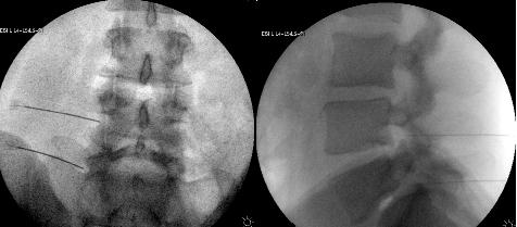 Epidural steroid injection in lumbar spine