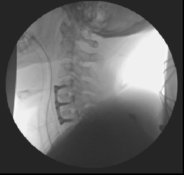 Cervical Discectomy and Fusion Works