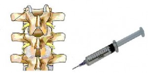 Epidural Steroid Injections And Compression Fractures