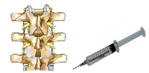 Cervical Selective Nerve Block