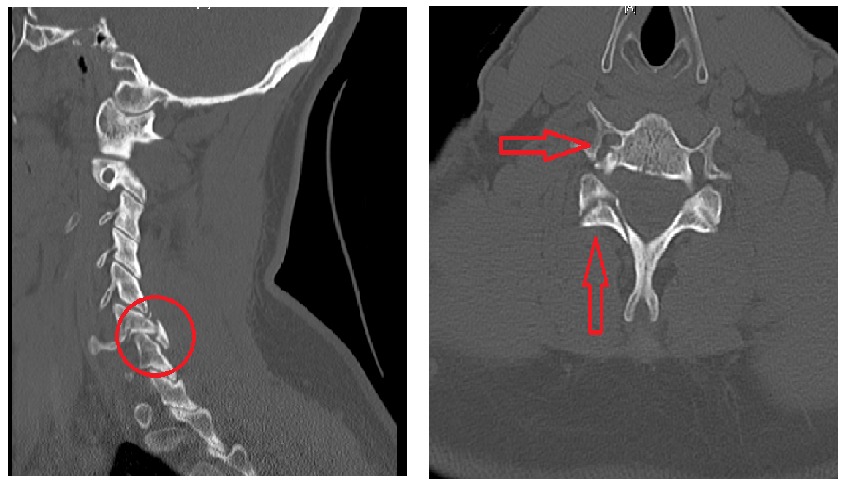 Cervical Neck Fractures