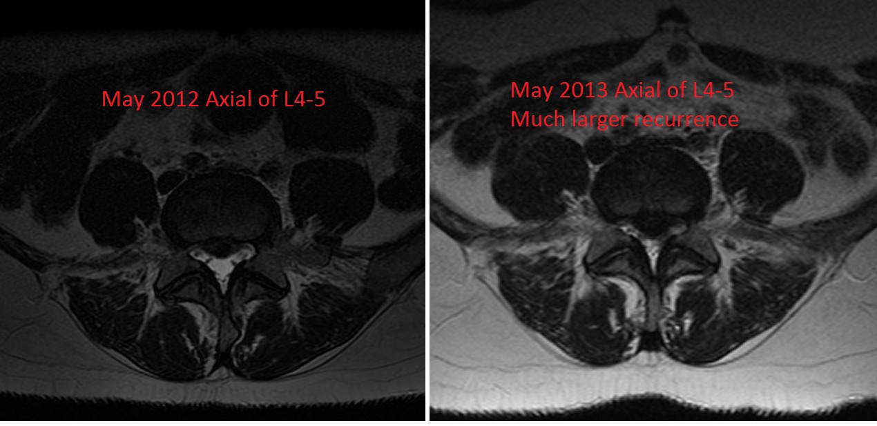 Axial-MRI-of-Recurrent-HNP