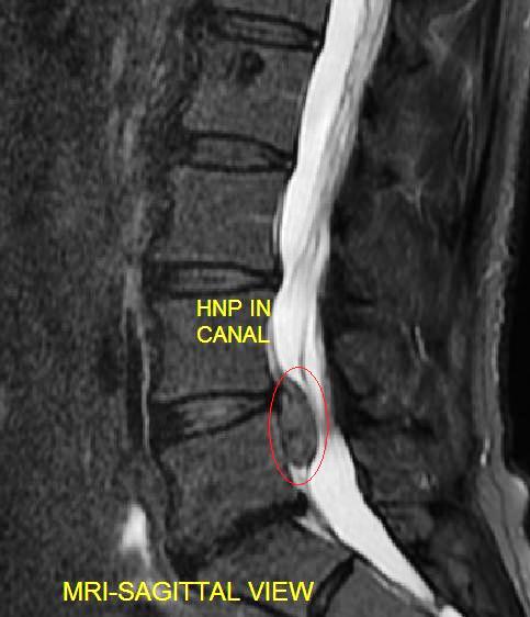 Percutaneous Discectomy