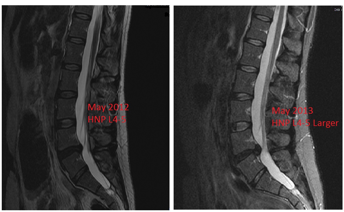 Recurrent Herniated Nucleus Pulposus