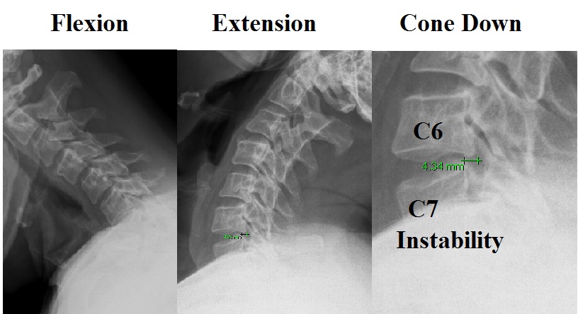 Cervical Instability