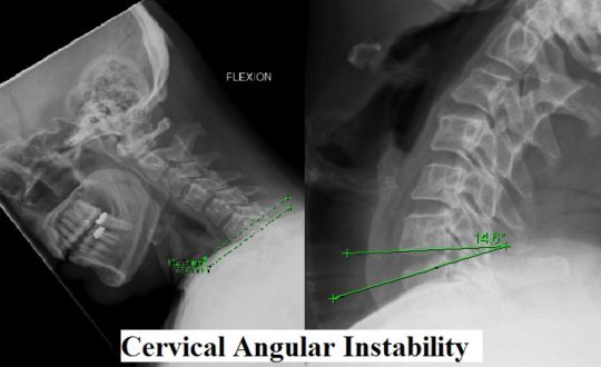 cervical spine instability icd 10