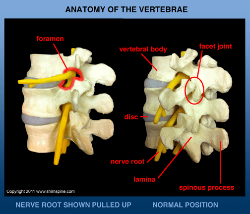 Why we have Disk Herniations