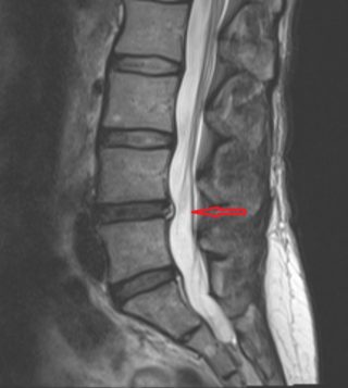 HIZ lesion, Sagittal