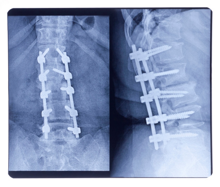 Your Chance of having  spine surgery may depend on where you live.
