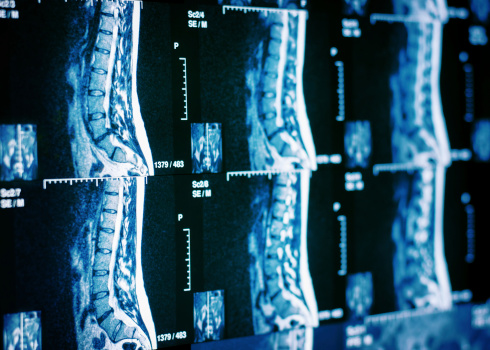 Disc Degeneration Causes Abnormal Motion