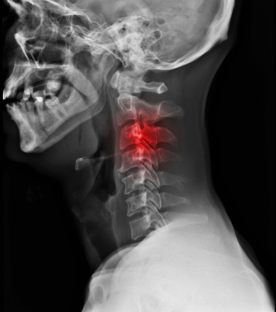 Spinal Cord Injuries