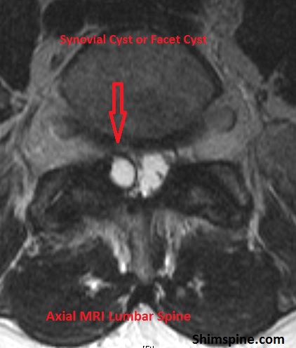 What is a synovial cyst?