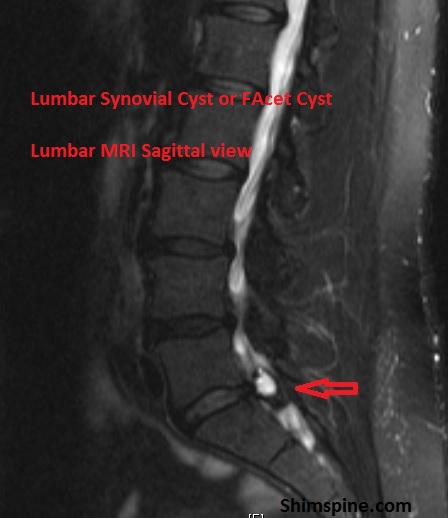 Saggital MRI view of a Lumbar Synovial Cyst or Facet Cyst