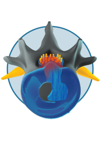 Cauda Equina Syndrome