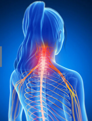 Cervical Radiculopathy