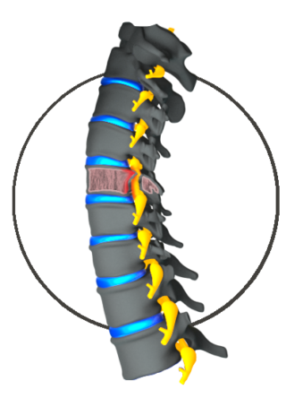 Cervical Stenosis