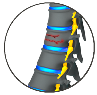 Spinal Compression Fracture