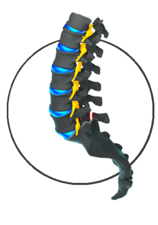 Lumbar Spondylosis