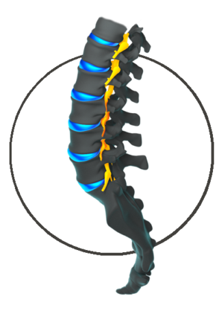 Lumbar Stenosis