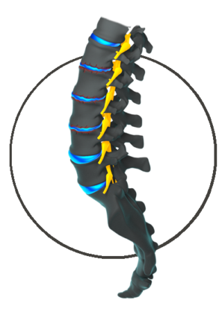 Lumbar Degenerative Disc Disease