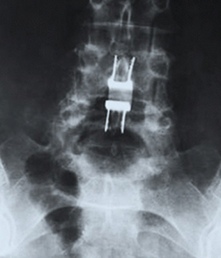 Lumbar Interspinous Spacer