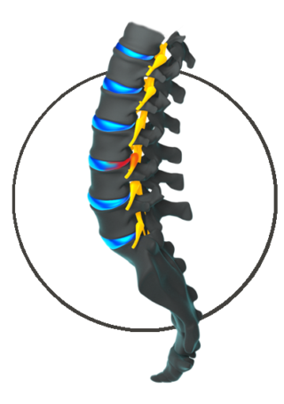 Lumbar Radiculopathy (Sciatica)