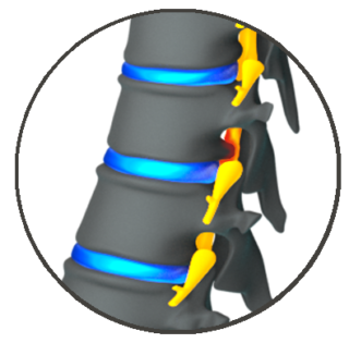 Thoracic Disc Herniation/Radiculopathy