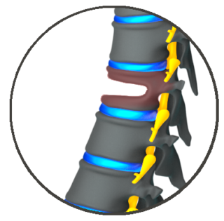 Thoracic Spinal Stenosis