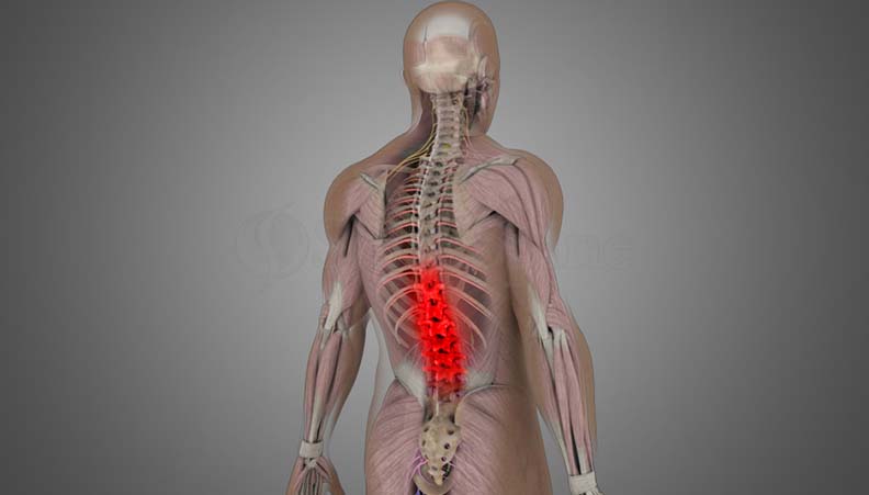 Mechanical Back Pain