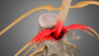 Lumbar Stenosis