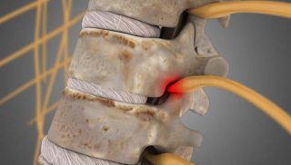 Lumbar Spondylosis