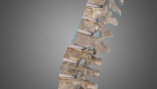 Lumbar Spondylolisthesis