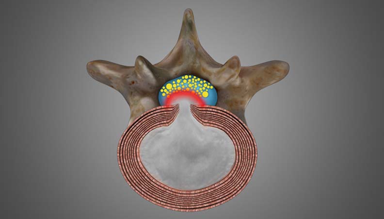 Lumbar Disc Herniation