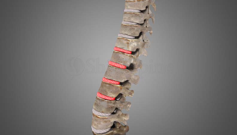 Lumbar Degenerative Disc Disease