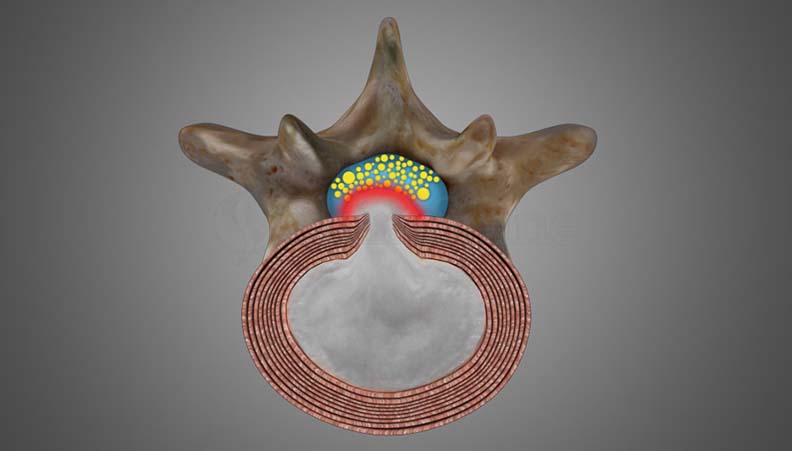 Cauda Equina Syndrome