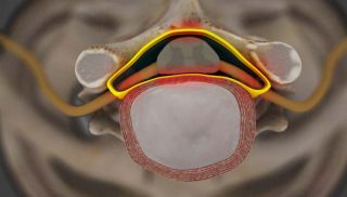 Cervical Spinal Stenosis