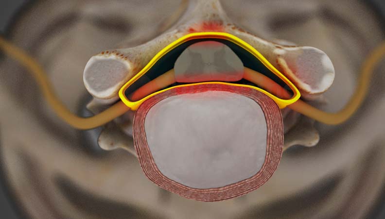 Cervical Stenosis