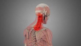 Cervical Sprain-Strain (Whiplash)