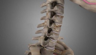 Cervical Spondylosis