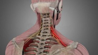 Cervical Radiculopathy