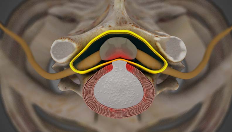 Cervical Myelopathy