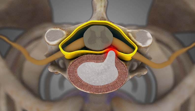 Cervical Disc Herniation