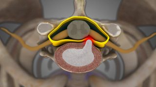 Cervical Disc Herniation