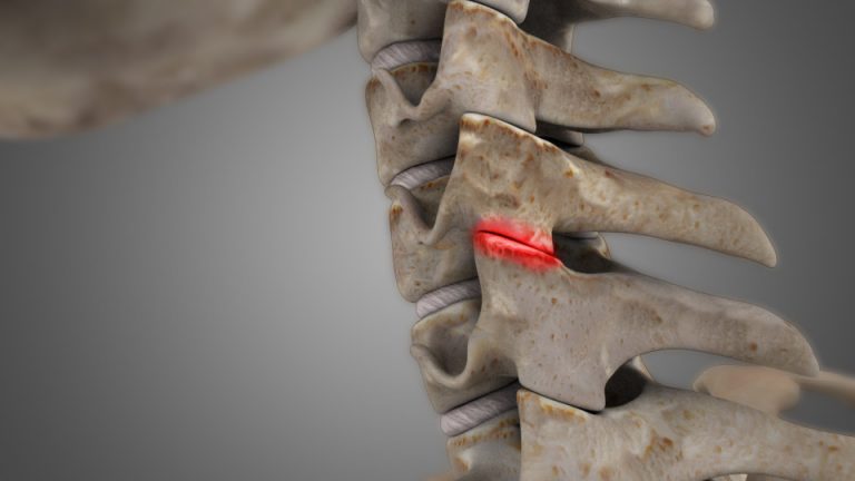 cervical spine facet syndrome icd 10